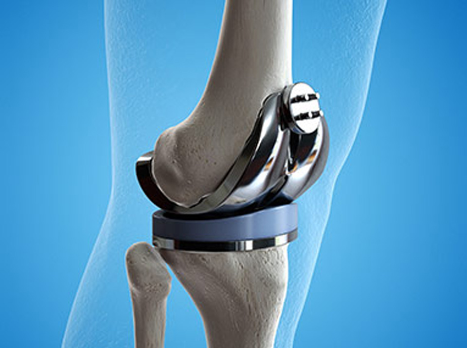 Knee Prosthesis